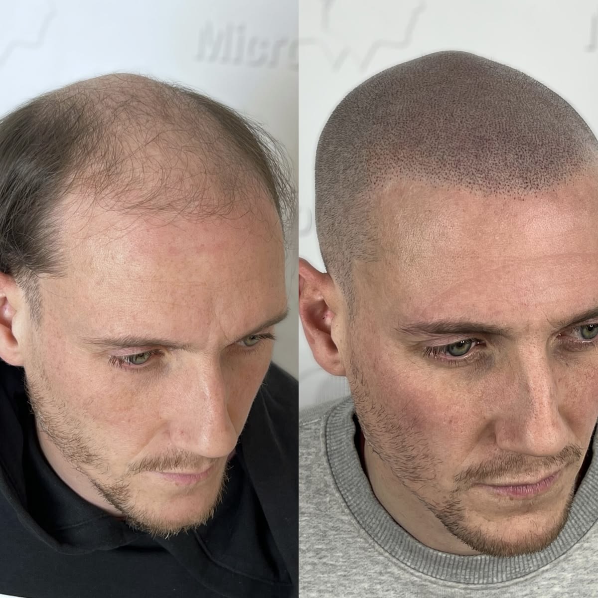Scalp Micropigmentation Density