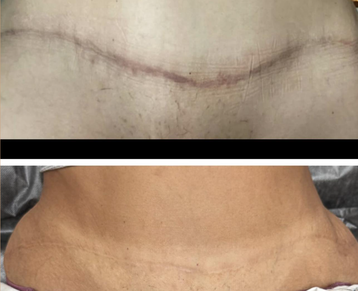 Scar Camouflage Tummy tuck Before and After