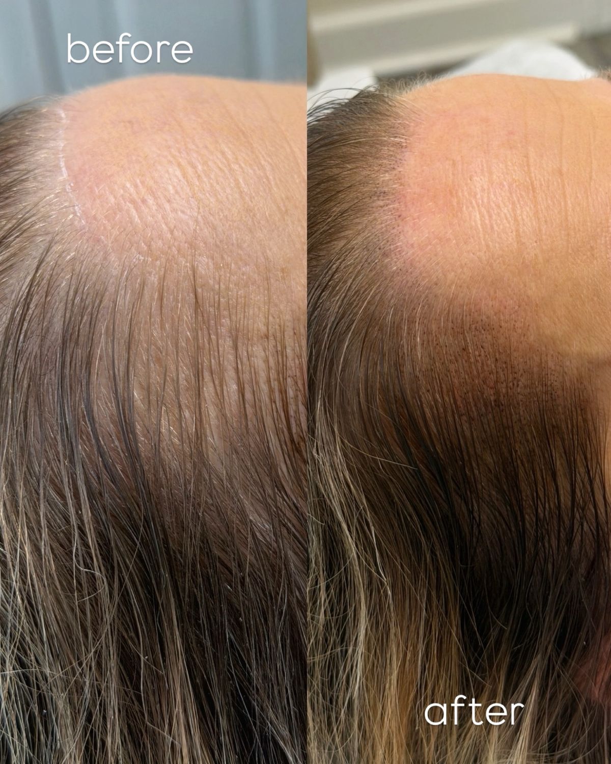 SMP Hairline Restoration